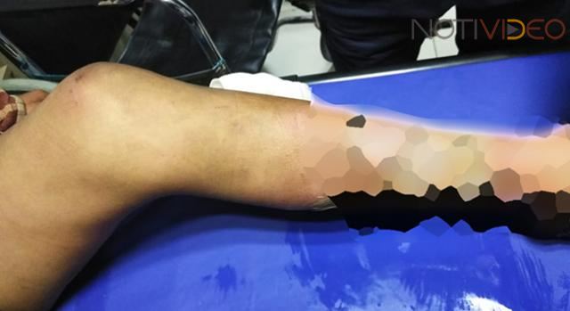 Menor sufre quemaduras al estallarle pirotecnia en su pantalón 